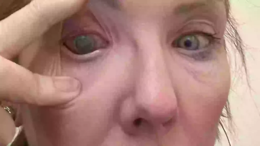 Woman left ‘almost completely blind’ in one eye after making common contact lens mistake