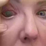 Woman left ‘almost completely blind’ in one eye after making common contact lens mistake