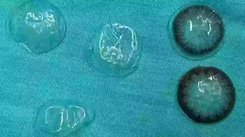 Doctors issue warning after removing five contact lenses from behind woman’s eye that she had no idea were there