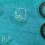 Doctors issue warning after removing five contact lenses from behind woman’s eye that she had no idea were there